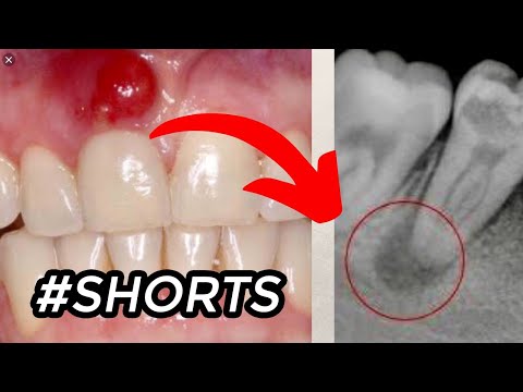 Vídeo: Per què la càries dental és una mal altia infecciosa?