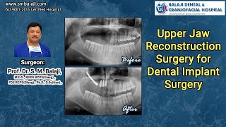 Upper Jaw Reconstruction Surgery for Dental Implant Surgery