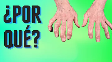 ¿Cuáles son las deformidades de los dedos?