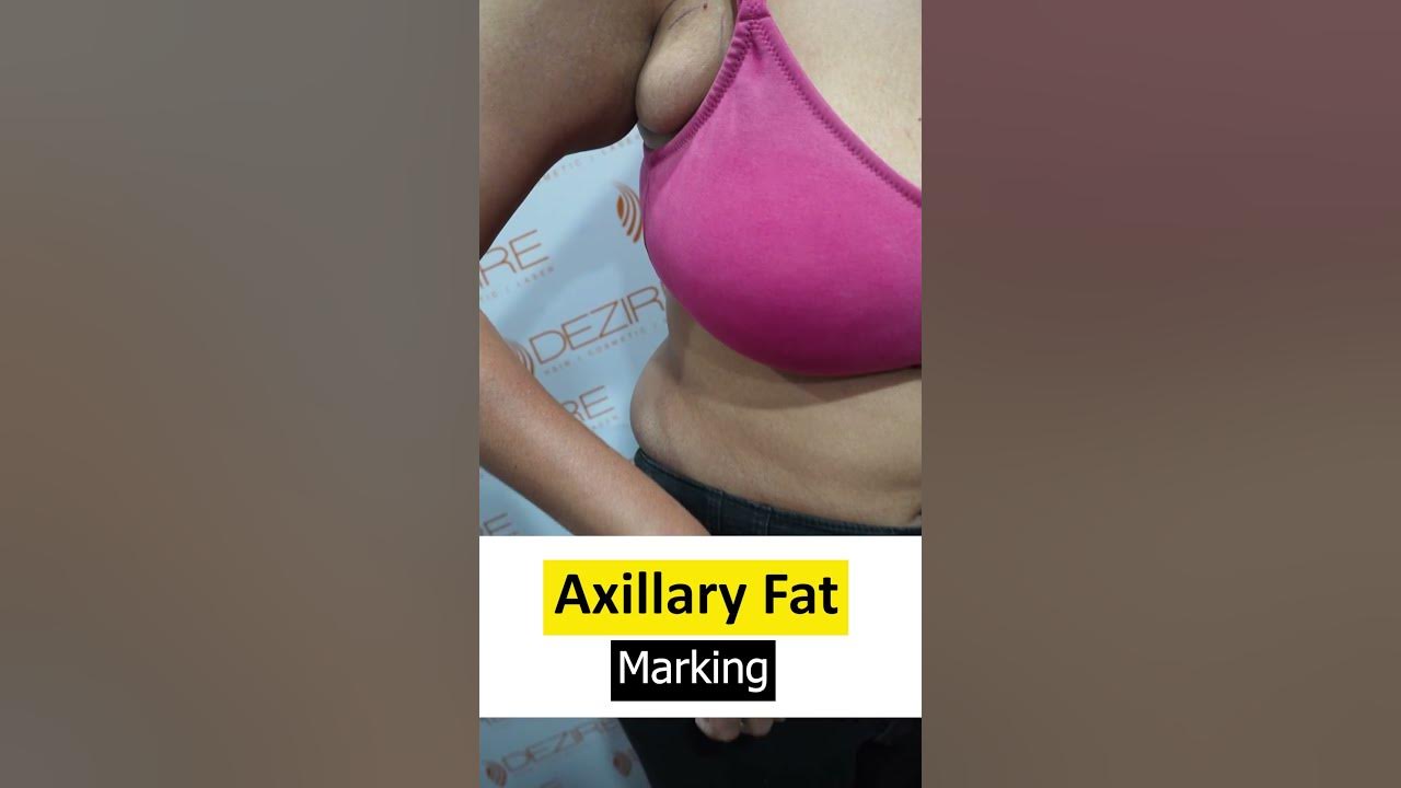axillary-fat-removal-planning-how-to-get-rid-of-axillary-fat-shorts