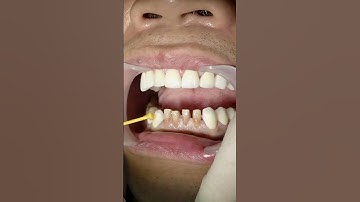 Răng sứ veneer thẩm mỹ giải pháp cho nụ cười tự tin  #veneers #rangsuthammy