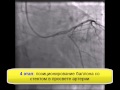 Реканализация и стентирование коронарных артерий