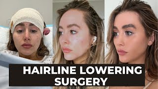 HAIRLINE LOWERING SURGERY VLOG + thread lift removal