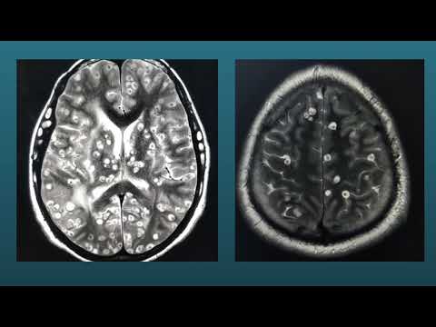 NEUROCYSTICERCOSIS & MYOCYSTICERCOSIS|| NEUROINFECTIONS|#YOUTUBERADIOLOGYSHORTS|OCULARCYSTICERCI