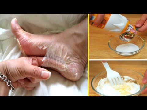 She Rubs Baking Soda On Her Feet 2x Per Week, The Result is Stunning! baking soda and vinegar for