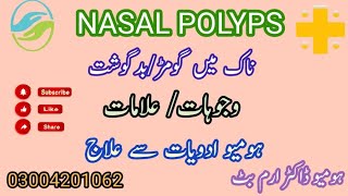 NASAL POLYPS #nsalpolyps #inflammation #nose #asthma #sinusitis #hayfever #allergies #rhinitis