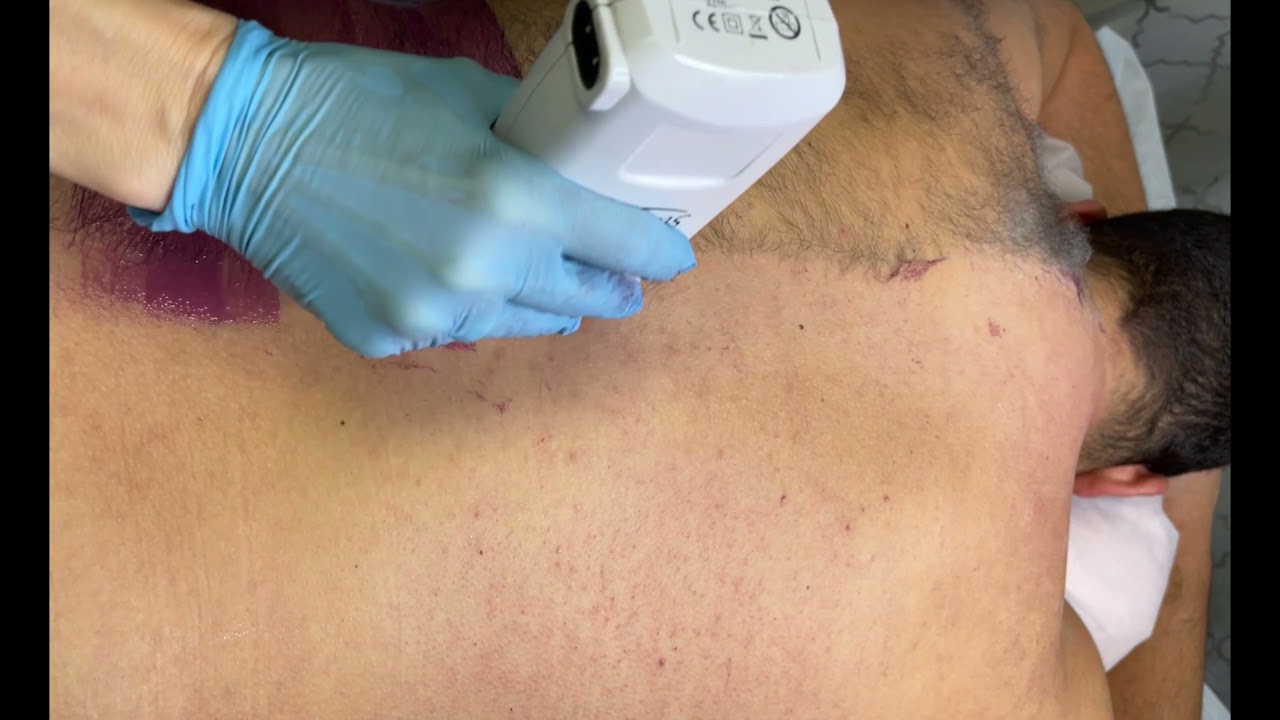 Full Back Waxing Hair Removal for Men. Clearwater Wax Services