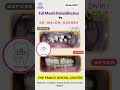 FULL MOUTH REHABILITATION@ The Family Dental Denter