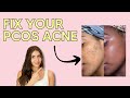 Breaking Out with PCOS? Let’s Talk About It (feat. Ali Grean, PA-C)
