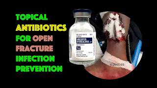 Topical Antibiotics in Open Fractures screenshot 4