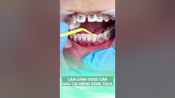 Cận Cảnh Gắn Mắc Cài Niềng Răng Thưa | Bác sĩ Thoa Bình Dương