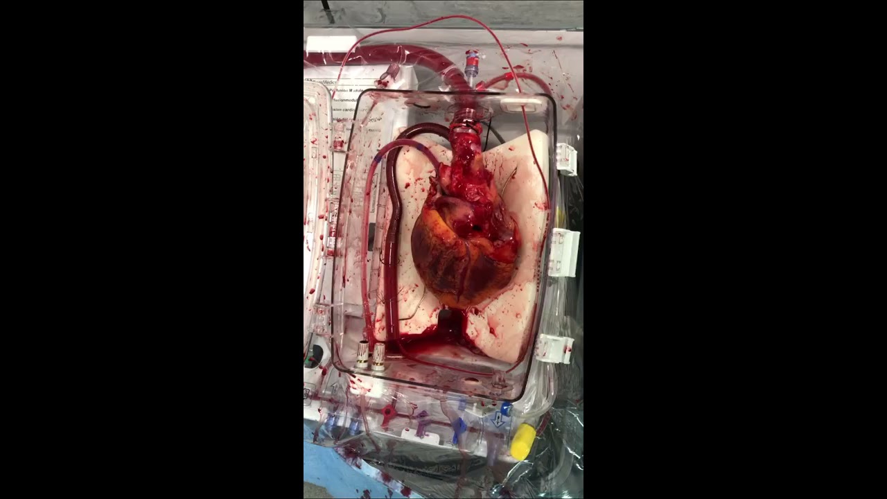 Donation After Circulatory Death DCD Heart Transplant
