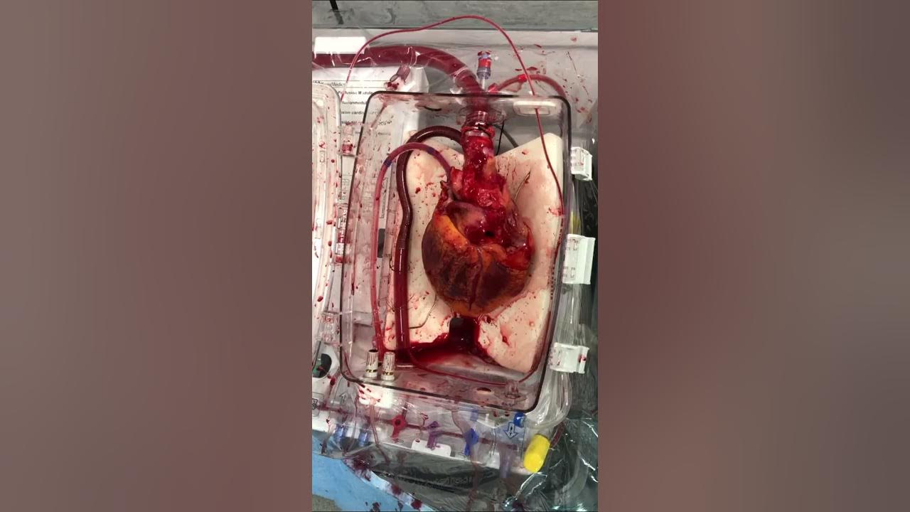 Donation after circulatory death (DCD) heart transplant