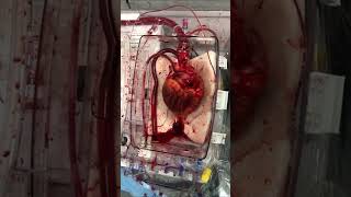 Donation after circulatory death (DCD) heart transplant