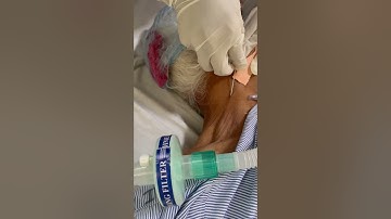 EJV (External Jugular vein ) Cannulation 💉