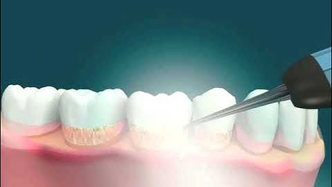 Dental Video for Prophylaxis - The Tooth