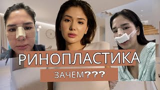 💥РИНОПЛАСТИКА / Реабилитация / До и После