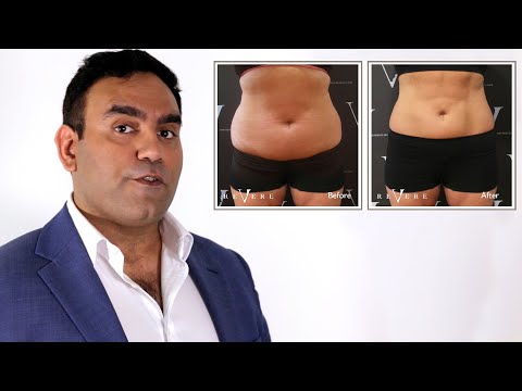 Video: CoolSculpting: Voorbereiding, Procedure, Kosten, Voor En Na