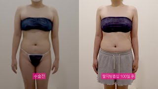 바비라인의원 팔지방흡입 3개월 후 전후영상