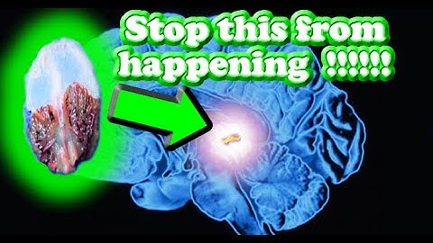 5 ways to decalcify the PINEAL GLAND