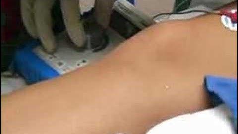 Femoral Block (sample) - www.proceduresconsult.com