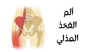 ألم الفخذ المذلي : ما هو سبب حرقان الفخذ؟ وكيف يتم علاج ألم الفخذ المئلي؟