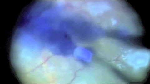 Subretinal Brilliant Blue G