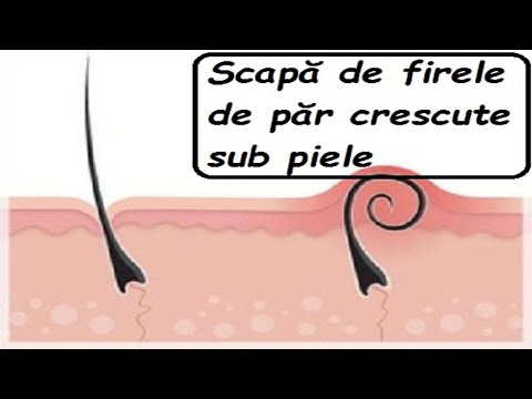 Video: Pseudofoliculita - Cum Să Scapi De Firele De Păr încarnate în Zona Bikini, Pe Picioare, Pe Corp