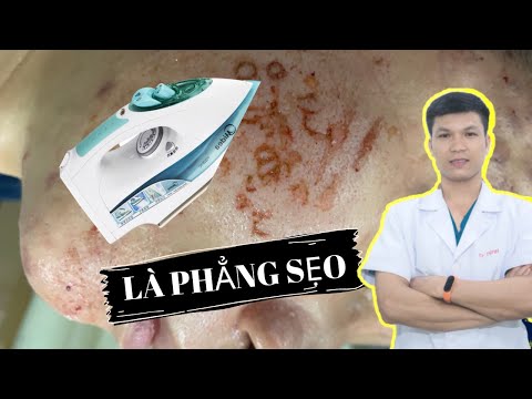 LÀ SẸO CO2, HẾT SẠCH SẸO LÕM 1 LẦN| Trị sẹo lõm| Dr Ninh Treatment acne Scar 2019