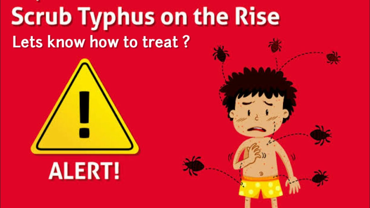 ⁣An Introduction to typhus disease | typhus fever treatment | typhus fever | typhus symptoms | typhus