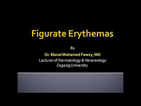 Video: Erythema Annulare Centrifugum: Symptome, Behandlung, Hausmittel