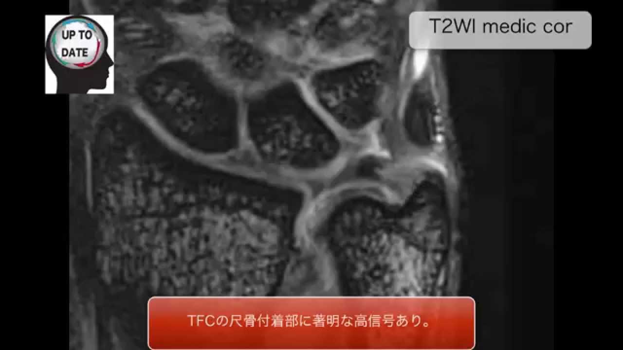 Tfcc損傷とは Mri画像診断のポイントは