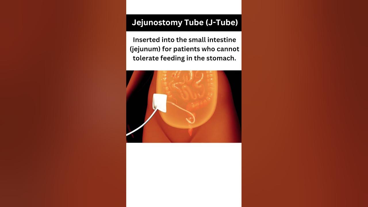 A J-tube (jejunostomy tube) is a medical device used to deliver
