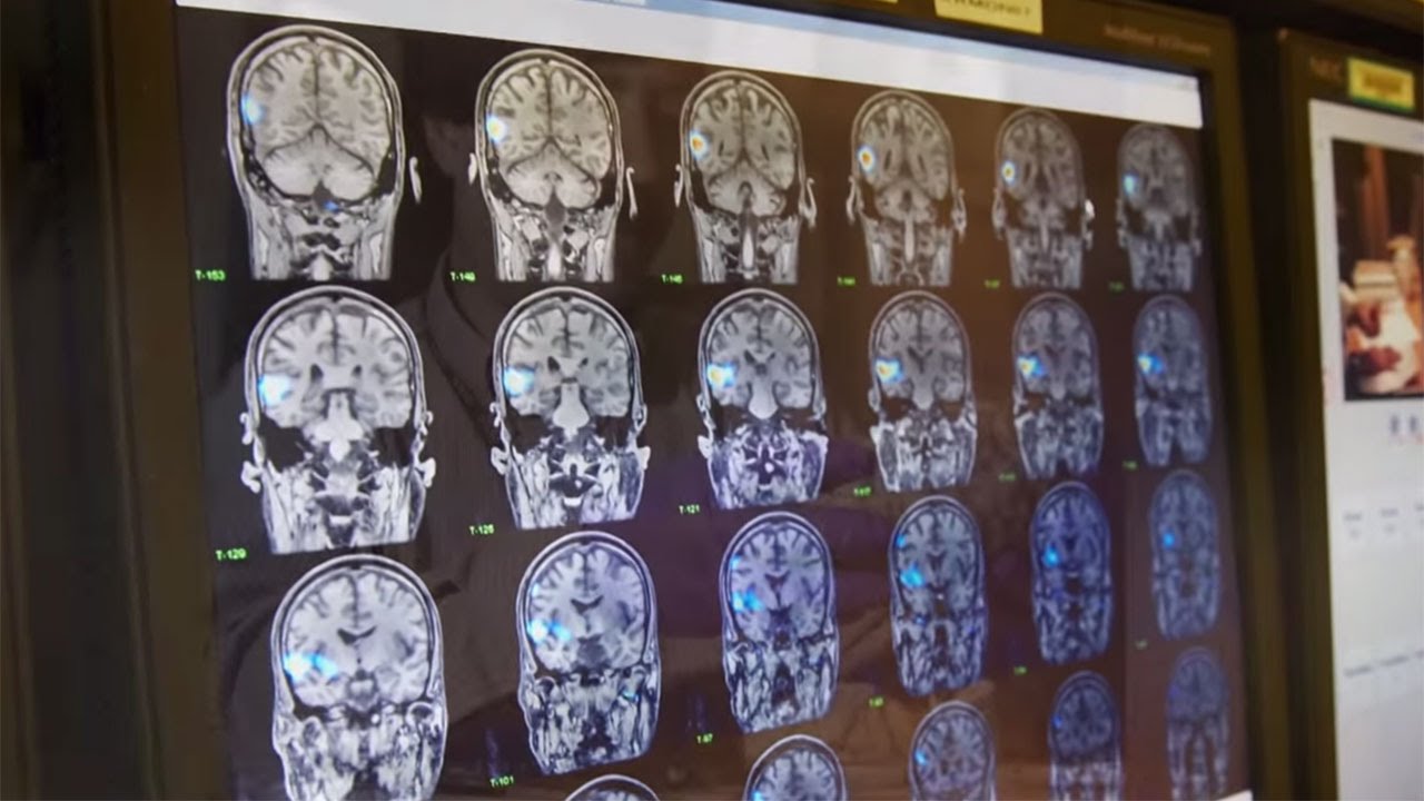Alzheimer's Disease Research at Rush - YouTube