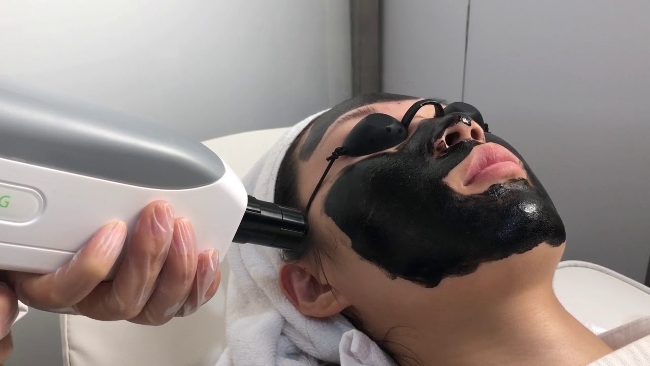Q switched nd yag laser Carbon Peeling for face skin rejuvenation