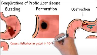 Gastric ulcer and duodenal ulcer in 2 minutes.  Peptic ulcer disease