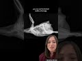 Veterinarian Discusses Chicken X-Rays: Egg Binding and Dystocia