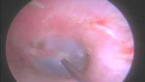 Endoscopic Intratympanic Steroid Injection .