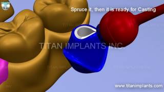Restoration Using UCLA Plastic Sleeve Compatible with Calcitek Intergral Spline