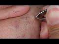 【kenuki006】persistent hairs しつこい毛達