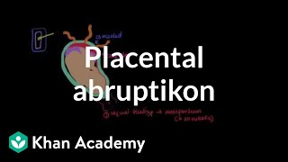 Placental abruption | Reproductive system physiology | NCLEX-RN | Khan Academy