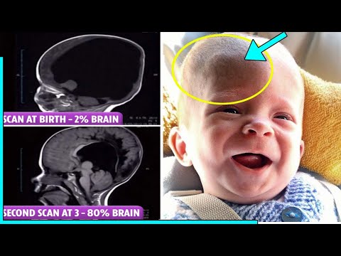 THE BOY WITH 'NO BRAIN' Boy born with MISSING brain defies huge odds to live | after it GREW back
