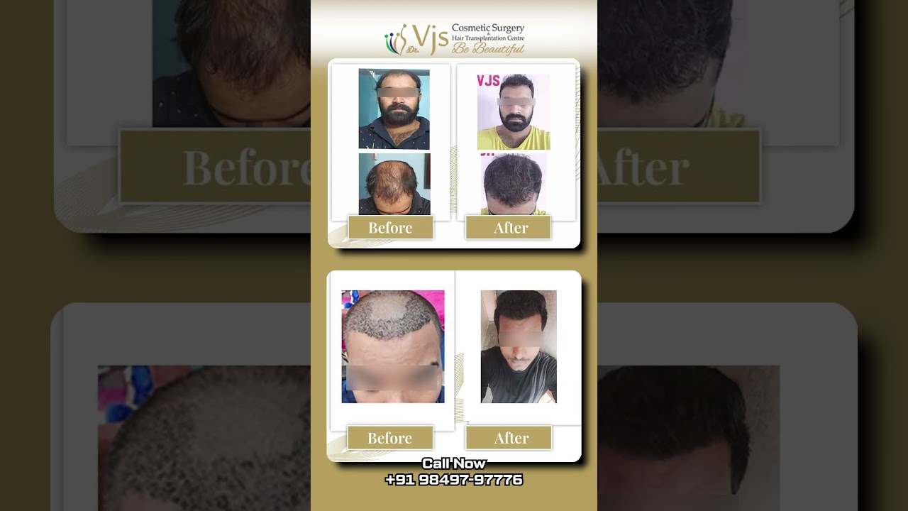 From Hair Loss to Hair Growth | Real Hair Transplant Results in Vizag | VJ’s Clinics