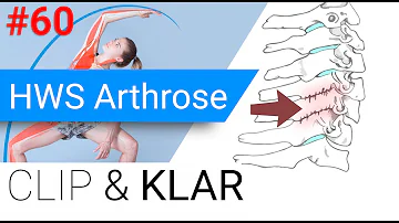 Was tun bei Arthrose in der Halswirbelsäule?