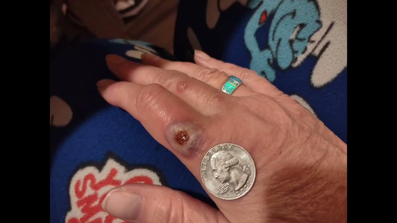 Does Mrsa Look Like A Spider Bite
