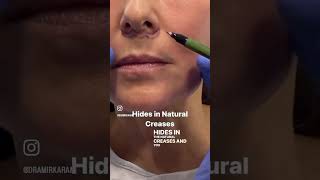 BULLHORN INCISION!!?? Dr. Amir Karam&#39;s Facelift Bullhorn Incision!