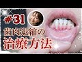 #31 歯肉退縮の治療方法