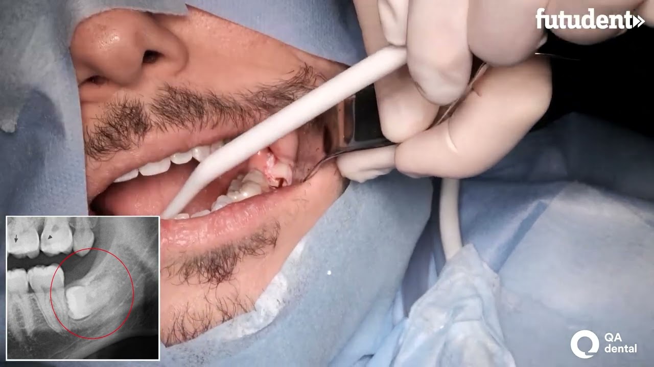 ⁣Upper and lower wisdom tooth surgical extraction