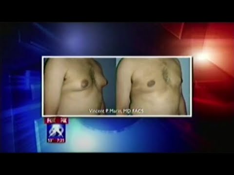 Type 4 Gynecomastia definition and treatment options