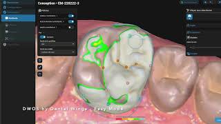 Soft Dwos V15 By Dental Wings